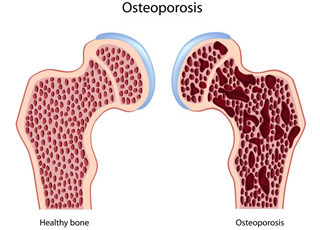 Osteoporose