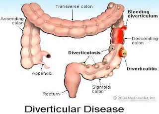 Diverticulose e Diverticulite