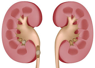 Cálculo e Doença Renal